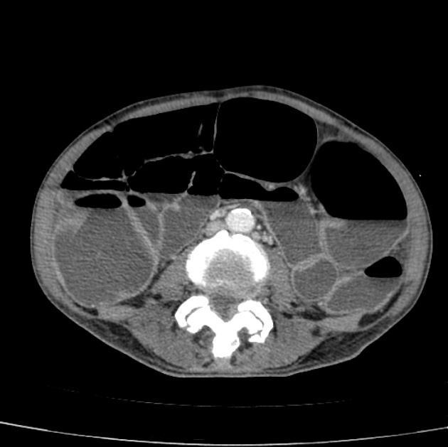 Obrázek 6: CT axiální řez - paralytický ileus Zdroj:https://radiopaedia.org/cases/paralytic-ileus-1 Ileus cévní je následkem trombózy nebo embolie mezenteriálních cév.