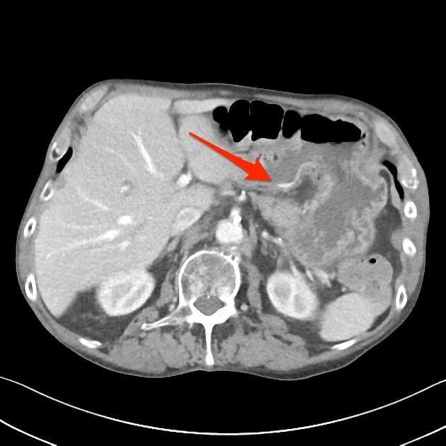 Obrázek 7 CT axiální řez - krvácení do GIT Zdroj: https://radiopaedia.org/articles/upper-gastrointestinal-bleeding 3 Zobrazovací metody 3.