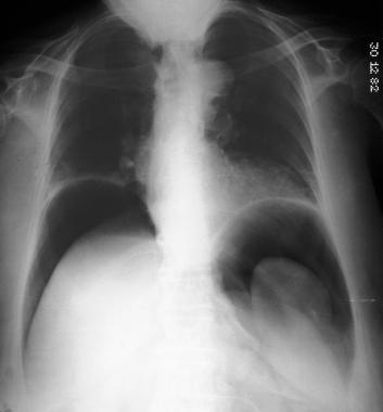 Obrázek 8: RTG snímek - pneumoperitoneum Zdroj:https://emedicine.medscape.com/article/372053-overview 3.2 Ultrasonografie Vyšetření pomocí ultrazvuku je nedílnou součástí vyšetření NPB.