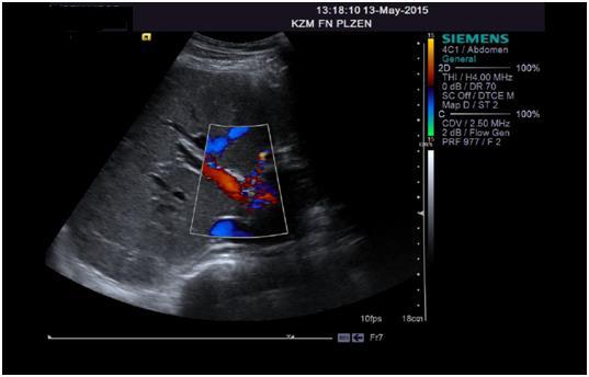 Obrázek 11: Ultrasonografie břicha Zdroj: FN Plzeň Pacient byl po operaci bez komplikací, rána se hojila dobře, stehy prozatím byly ponechány. Nemocnému byl doporučen tělesný klid, dostatek tekutin.