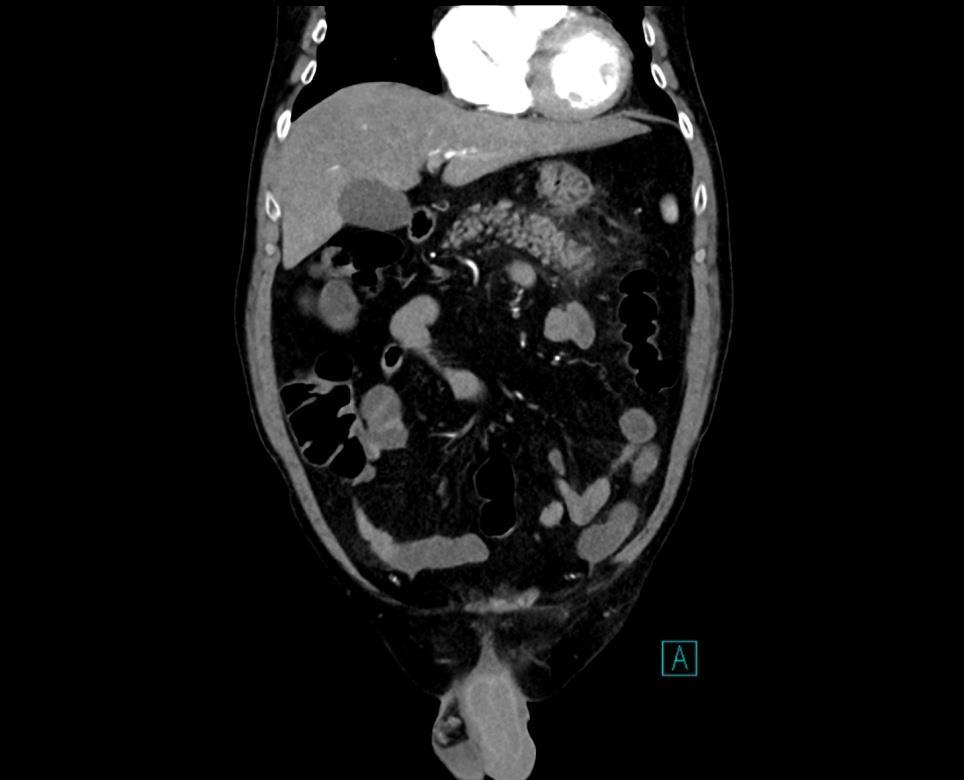 normálního vzhledu. Viscerální řečiště volné Játra, žlučník, pankreas, slezina, nadledviny a ledviny bez patologického nálezu v postkontrastním CT obraze.