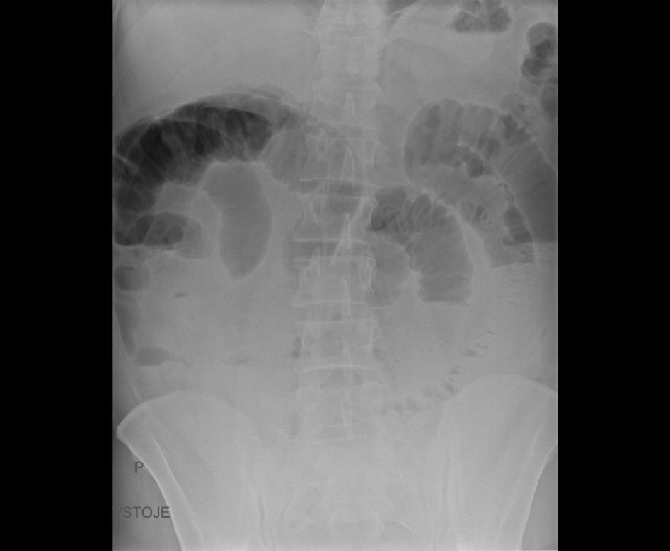 Obrázek 21: RTG snímek Zdroj: FN Plzeň Pacient pro upřesnění diagnózy poslán na CT vyšetření břicha. Vyšetření se bylo prováděno nativně. CT nález: Rozšíření tenkých kliček až na 45 mm, v obl.