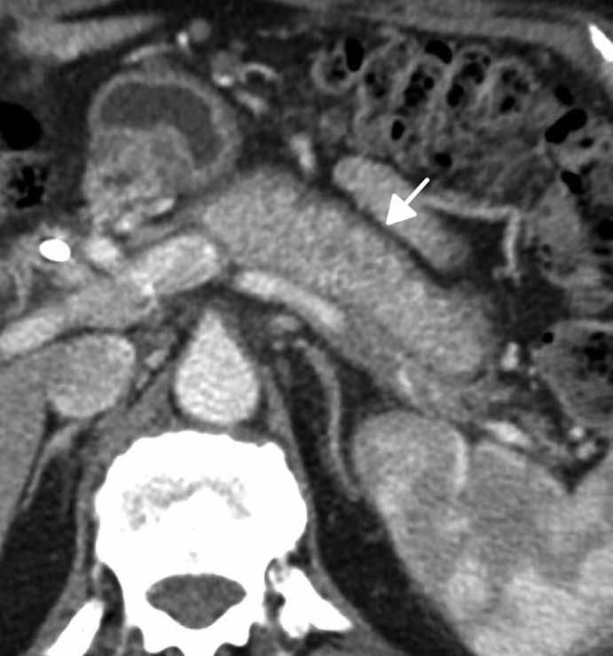 Summary Background: Immunoglobulin (Ig) G4 associated sclerosing cholangitis is a rare inflammatory disease of the biliary tract.