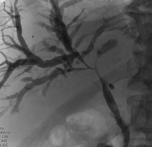 Obr. 2. Cholangiografie typ IV (stenotizace hilové oblasti). Obr. 3.