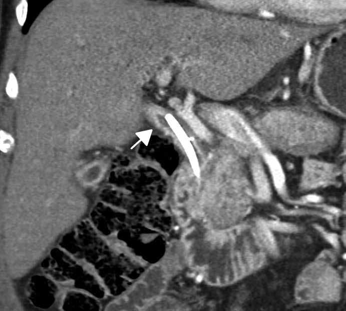 Obr. 9. Zesílení stěny ductus choledochus, duodenobiliární drén in situ (CT vyšetření s aplikací kontrastní látky, koronární rekonstrukce). Obr. 10.