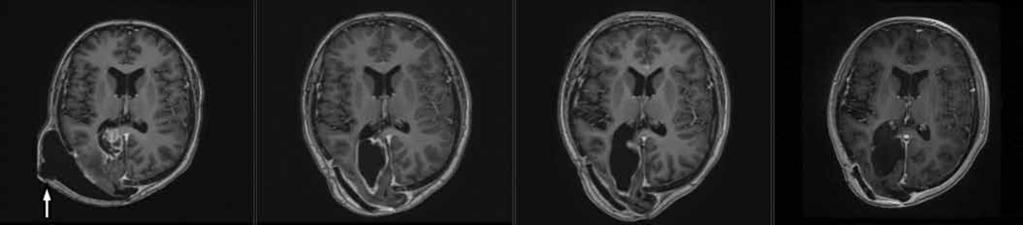 A B C D Obr. 4. MRI, T1 vážené obrazy s kontrastem pokračující léčebná odpověď.