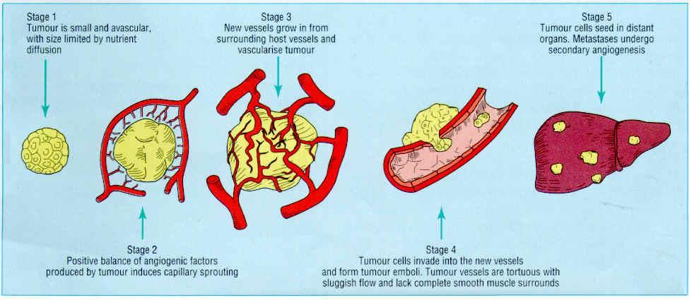 Stádia nádorového procesu Stádium 1 Malý avaskulární nádor Výživa nádoru difúzí Stádium 3 Růst nových cév Vaskularizace tumoru Stádium 5