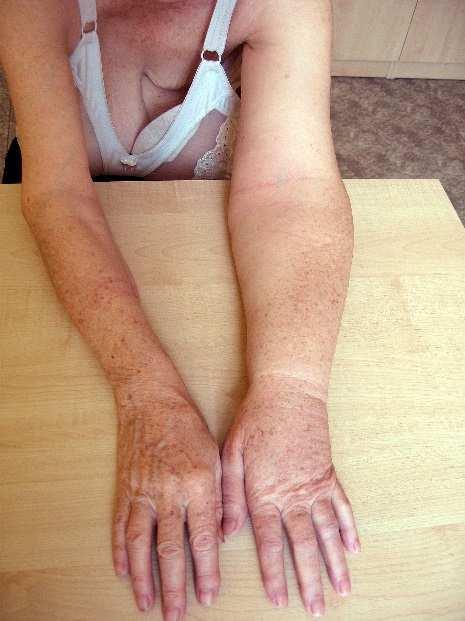4. LEE, Y. M. 2001.Lymphoedema care of brest cancer patients in a brest care Clinic: asurvey of knowledge and health practise. Support Care Cancer. 2001 Nov;9(8):634/41.ISSN 0941-4355. 5.
