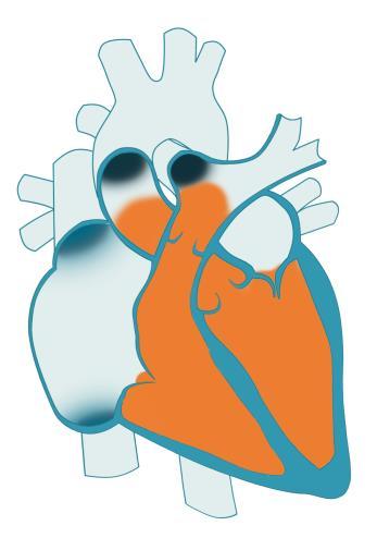 v Arteriální krevní tlak jiný pohled Krevní tlak je dán tím, kolik krve za čas do arteriálního řečiště vtéká (CO) a jak snadno krev odtéká (R) CO = SV*HR Krevní tlak R