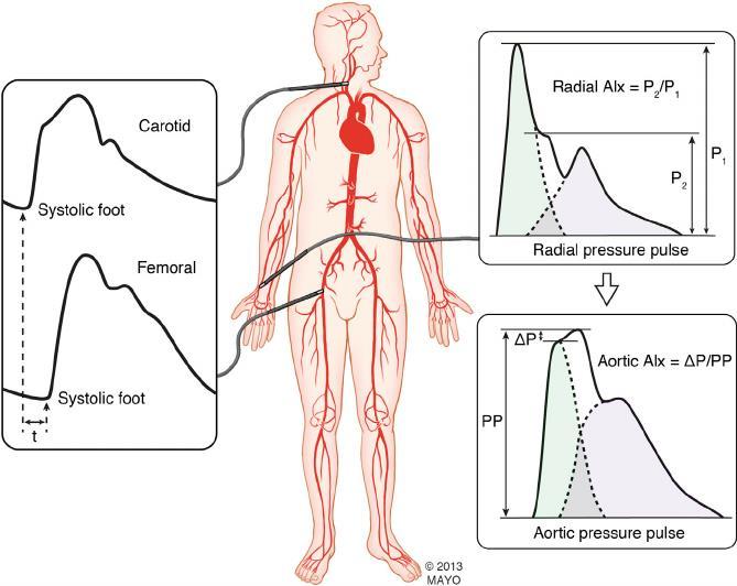 Rychlost pulzové vlny rychlost šíření pulzové vlny od srdce do periferie PWV (puls wave velocity) se zrychluje při zvýšené tuhosti cév aortou se šíří pomaleji než periferními arteriemi tvar pulzové
