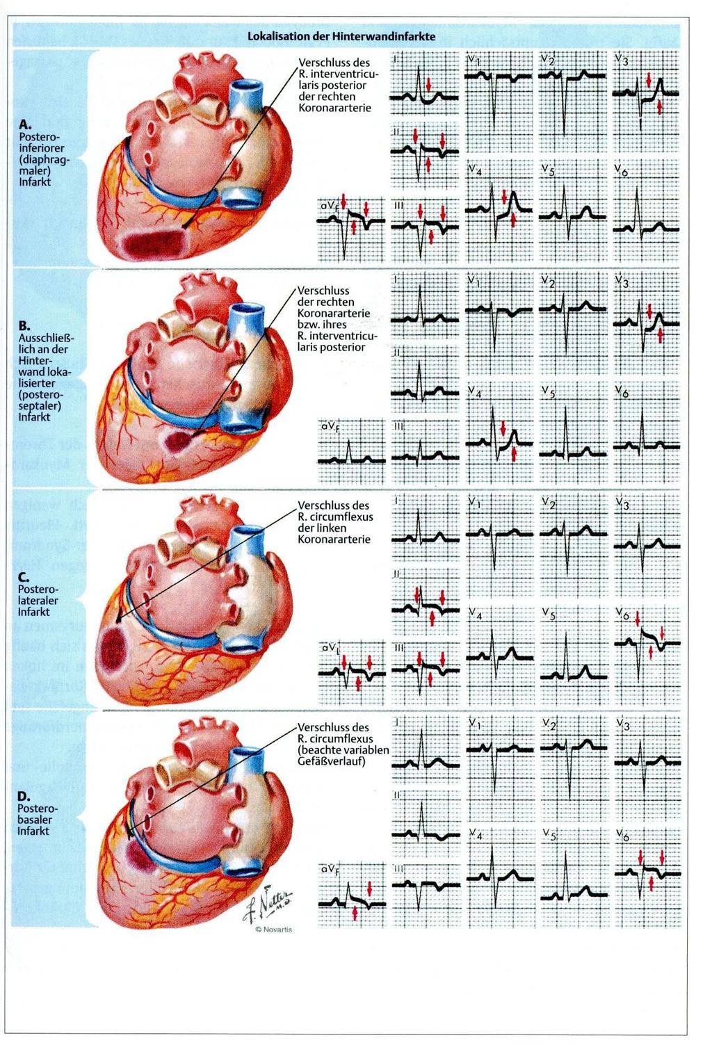 Infarkt