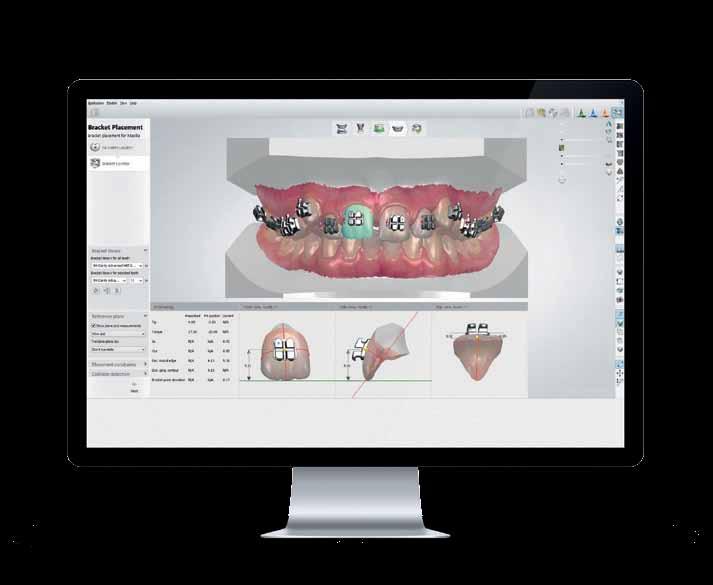 3Shape Rozšíření možností léčebných postupů: Digitální otisk