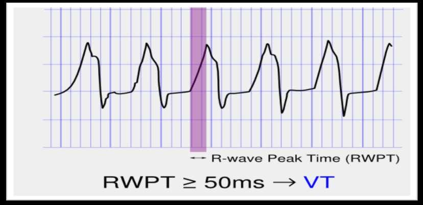 RWPT R Wave Peak Time Diferenciální