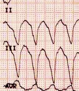 rychlý převod signálů pravým a levým Tawarovým raménkem rozšíření po subendokardiální ploše komor P. f. Tvar QRS kmitu je podpisem aktivace obou komor.