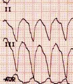 rychlý převod signálů pravým a levým Tawarovým raménkem rozšíření po subendokardiální ploše komor P. f. Tvar QRS kmitu je podpisem aktivace obou komor.