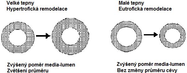 Orgánové komplikace esenciální hypertenze * 5.3 angiotensinem II spouštěná tvorba reaktivních forem kyslíku (Duprez, 2006; Kaplan et al., 2010).