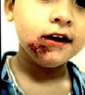 Streptococcus pyogenes