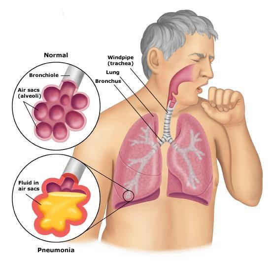 Streptococcus pneumoniae