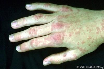 Arcanobacterium Patogenita: