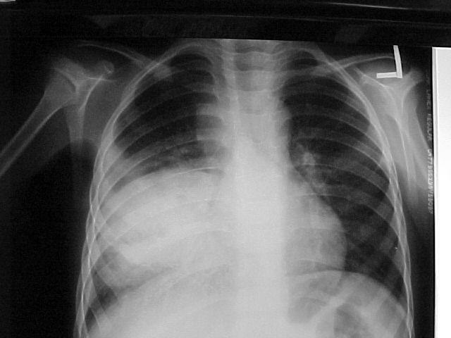 Nocardia patogenita a terapie Ohroženy imunokompromitované osoby