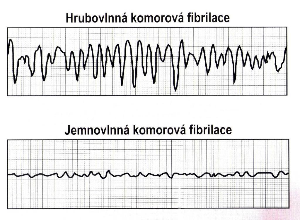 Komorová fibrilace kmitání komor neefektivní nekoordinované stahy srdeční