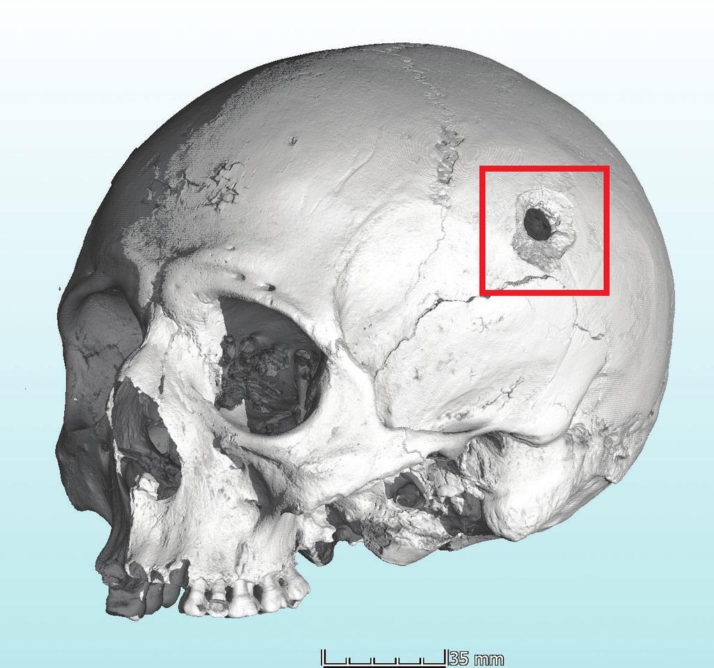 JAKÉ MOŽNOSTI CT PŘINÁŠÍ Využití CT ve forenzní antropologii: microct vyšetření střelných zranění na lebce Ve spolupráci s Laboratoří morfologie a forenzní antropologie (LaMorFA) Masarykovy