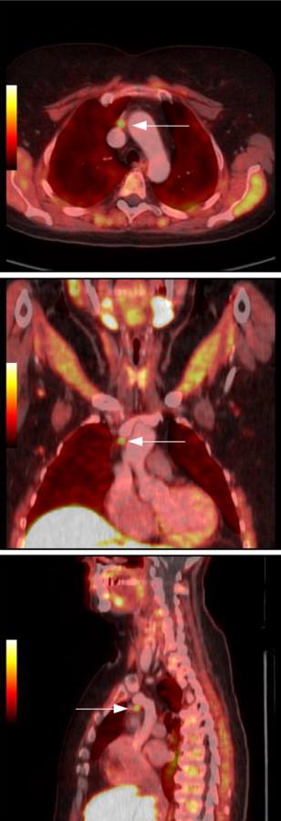 Obr. 7: PET/CT pomocí 18 F-FCH Vybrané řezy PET/CT pomocí 18 F-FCH s nálezem atypického