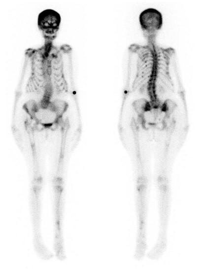 Obr. 8: Celotělová scintigrafie skeletu Scintigrafie skeletu se zvýšeným kostním metabolismem v oblasti