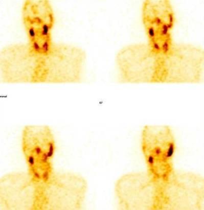 Obr. 12: SPECT pomocí 99m Tc-MIBI Vybrané koronální řezy časné fáze 99m Tc-MIBI/SPECT se zobrazením aktivity jak ve štítné žláze, tak v PT v oblasti dolních pólů štítné žlázy u 41 letého muže s RF a