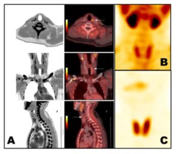 prováděna, a proto je doporučena právě při nejasných a negativních nálezech zjištěných pomocí protokolu A. Podobné snahy o využití PET/CT techniky při detekci PT lze najít v literatuře, např.