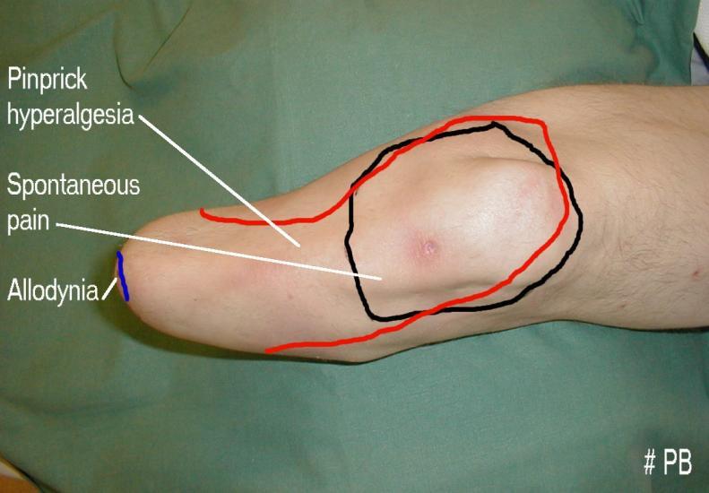 Cut and thrust: antecedent surgery and