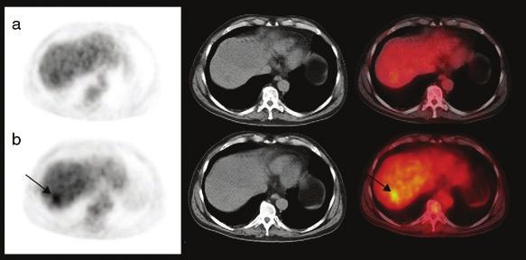 [1] Obr. 4: Axiální řezy jater zobrazeny metodou PET, CT a fúze obrazů PET/CT, a sice beze změn (a) a s metastázou (b).