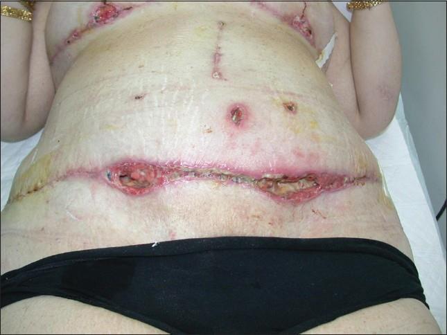 Pacientka po abdominoplastice infekce v ráně Zdroj: Rangaswamy M.