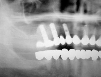 IMPLANTÁTŮ (MUDr. Z. Nathanský, CSc.