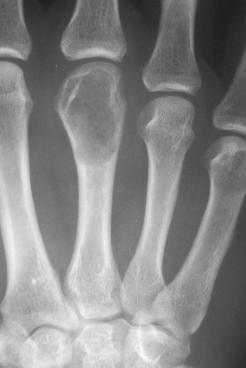 Klinické aplikace APLIKACE MATERIÁLU V CYSTĚ PAŽNÍ KOSTI S PATOLOGICKOU ZLOMENINOU Rozsáhlá cysta na