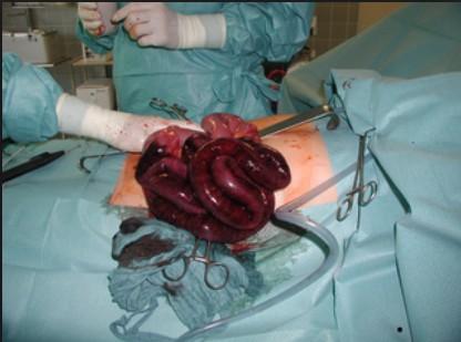 Cévní ileus Zúžení tepen v oblasti mesenterických tepen abdominální angina,