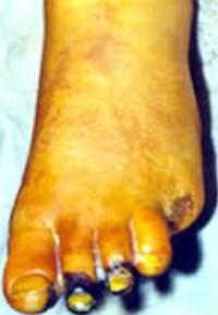 Buergerova choroba thrombangiitis obliterans II diagnostika pozitivita zánětlivých faktorů, na angiografii mrkvovitý tvar stenózy, stenózy lokalizovány v