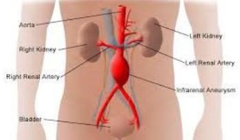 Aneuryzmata II diagnostika na dostupných místech palpací nebo poslechem, Doppler, angiografie, CT komplikace ruptura, embolizace z vaku, úplný