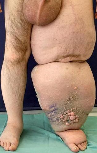 Lymfedém definice stáza v lymfatickém oběhu způsobující stázu lymfy v podkoží etiologie primární vrozené poruchy vývoje lymfatických cév, sekundární poruchy průchodnosti při nádoru, operaci, zánětu,