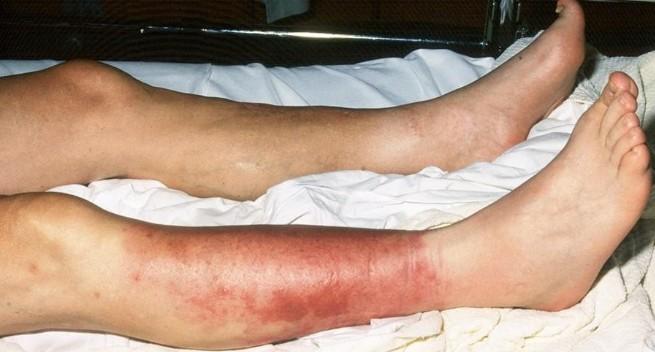 Eryzipel definice zánět kůže a podkoží způsobený beta-hemolytickým streptokokem etiologie oděrky a poranění