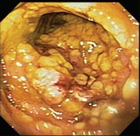 Infekce Clostridium difficile Kolonizace?