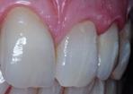 dentálních materiálů, přístrojů, služeb a technologií Praktické ukázky a workshopy InDent párty ESTECEM můžeme charakterizovat jako duálně tuhnoucí vysoce plněný (74%) pryskyřičný cement, který ve