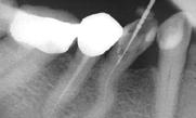 LEVÉ KŘÍDLO STŘEDNÍ HALA PRAVÉ KŘÍDLO FOYER Kořen ve tvaru písmene S rizika této velké výzvy v endodoncii 81letá pacientka se dostavila s