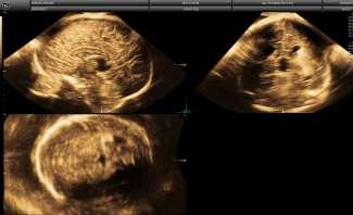 Ultrasound Obstet Gynecol 2018 Aboulghar, Fertil