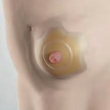 Nová konkávní pomůcka SenSura Mio Concave je k dispozici ve dvoudílné variantě ve čtyřech velikostech konkávních podložek od 40mm kroužku až po 70mm kroužek s mechanickým upínáním a čtyřmi oušky na