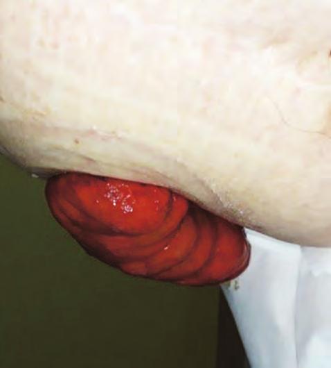 SenSura Mio Concave SenSura Mio Concave První pomůcka šitá na kýlu" V průběhu měsíce března jsme měli možnost vyzkoušet si v praxi novou pomůcku na našem trhu SenSura Mio Concave.