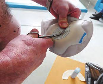 Při prvním osahání pomůcky lze říci, že jde o produkt nadčasový. Problematika vypouklého břicha či kýly v oblasti stomie se týká asi sedmi až osmi pacientů z deseti.