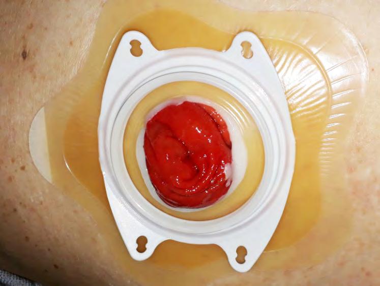 Jedná se především o aktivní pacienty středního věku, které vyboulení peristomální oblasti nebo peristomální kýla omezuje v běžných aktivitách či pracovním procesu.