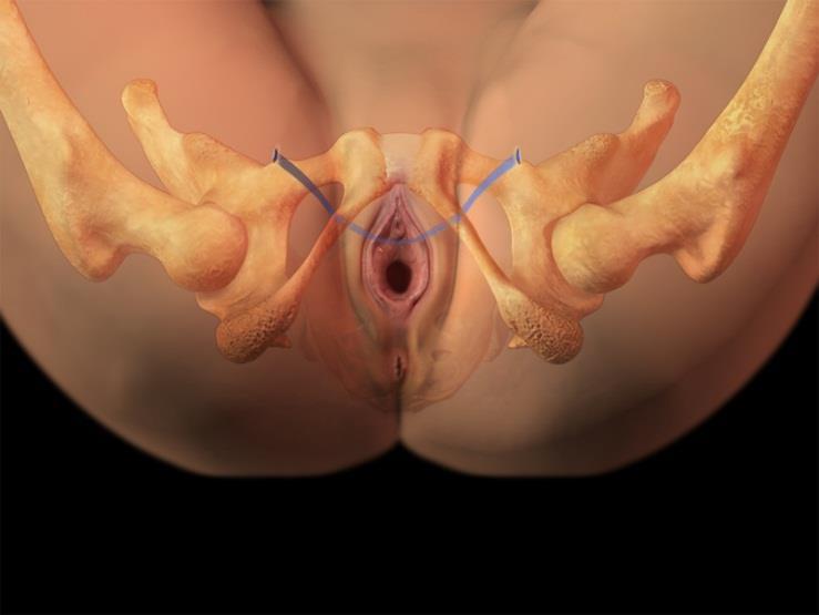 Operativní: - tahuprostá vaginální páska: retropubická a transobturatorní páska - operace sec.