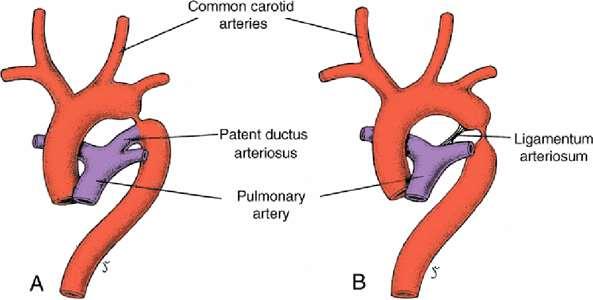 Koarktace aorty (3,2/10 000), lumen aorty je před odstupem levé a. subclavia významně zúžené.